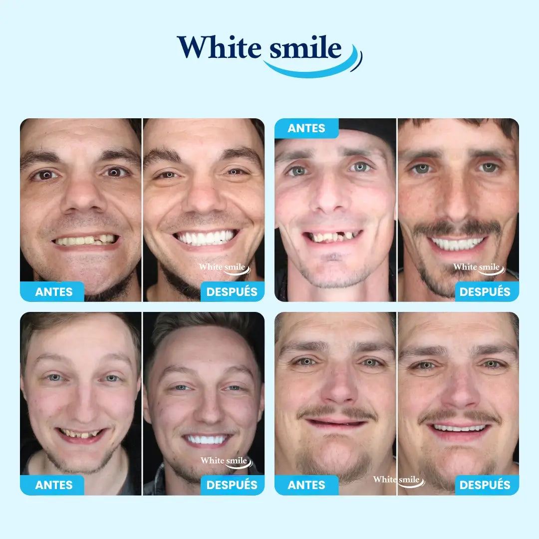 😁 SmileCover™ – Dientes Más Claros con Acabado Natural 🦷