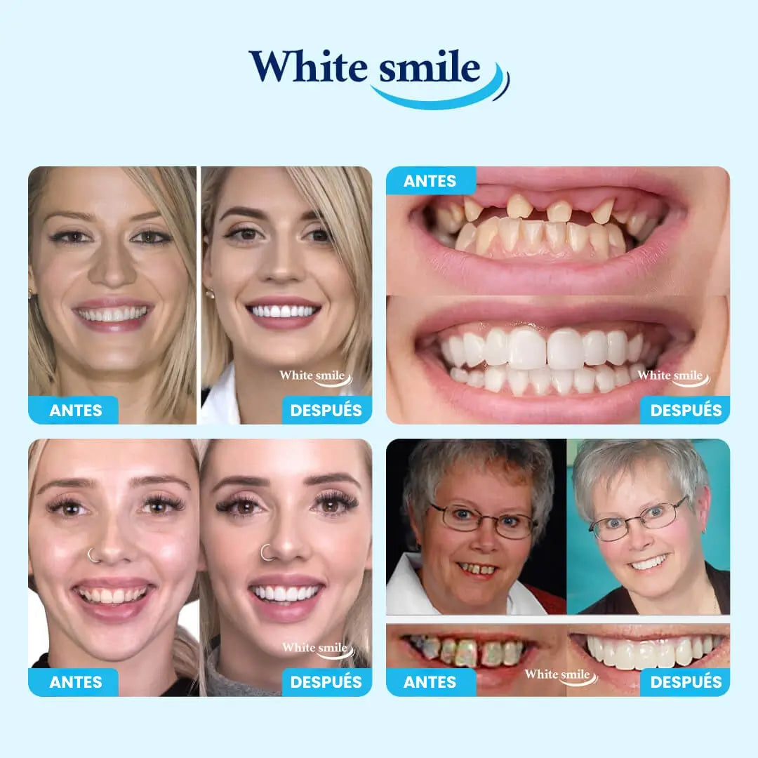 😁 SmileCover™ – Dientes Más Claros con Acabado Natural 🦷