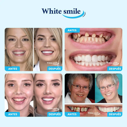 😁 SmileCover™ – Dientes Más Claros con Acabado Natural 🦷